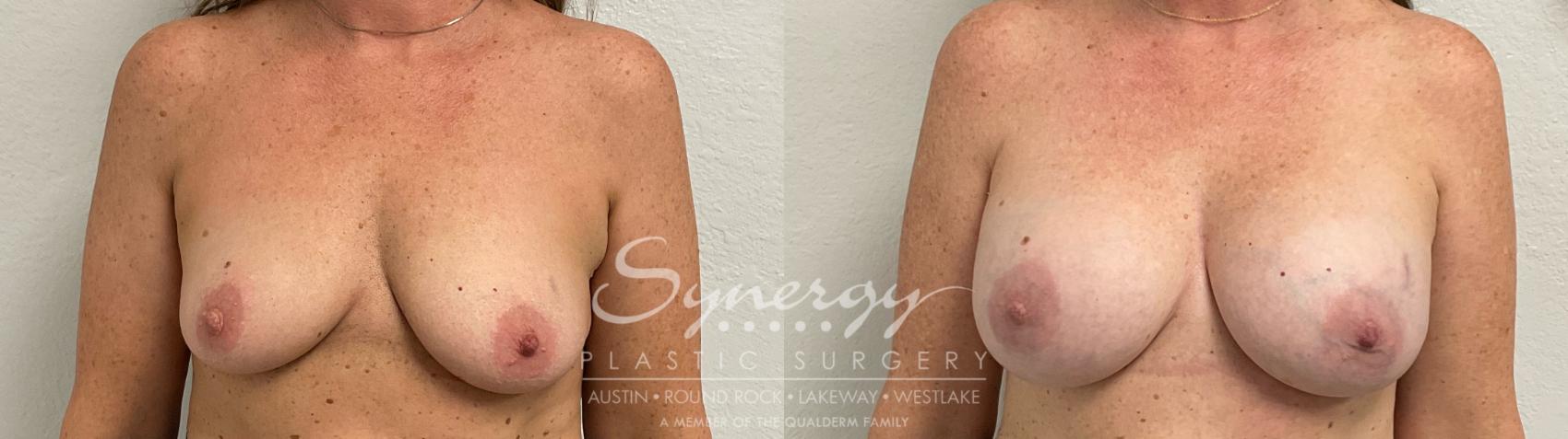 Before & After Breast Augmentation Case 952 Front View in Austin, TX
