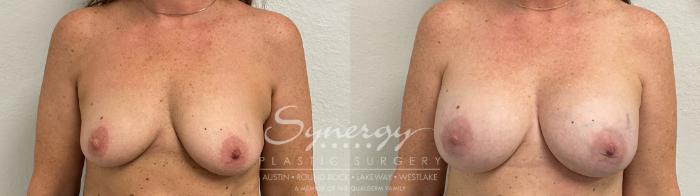 Before & After Breast Augmentation Case 952 Front View in Austin, TX
