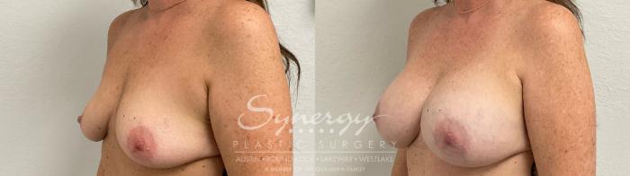 Before & After Breast Augmentation Case 952 Left Oblique View in Austin, TX