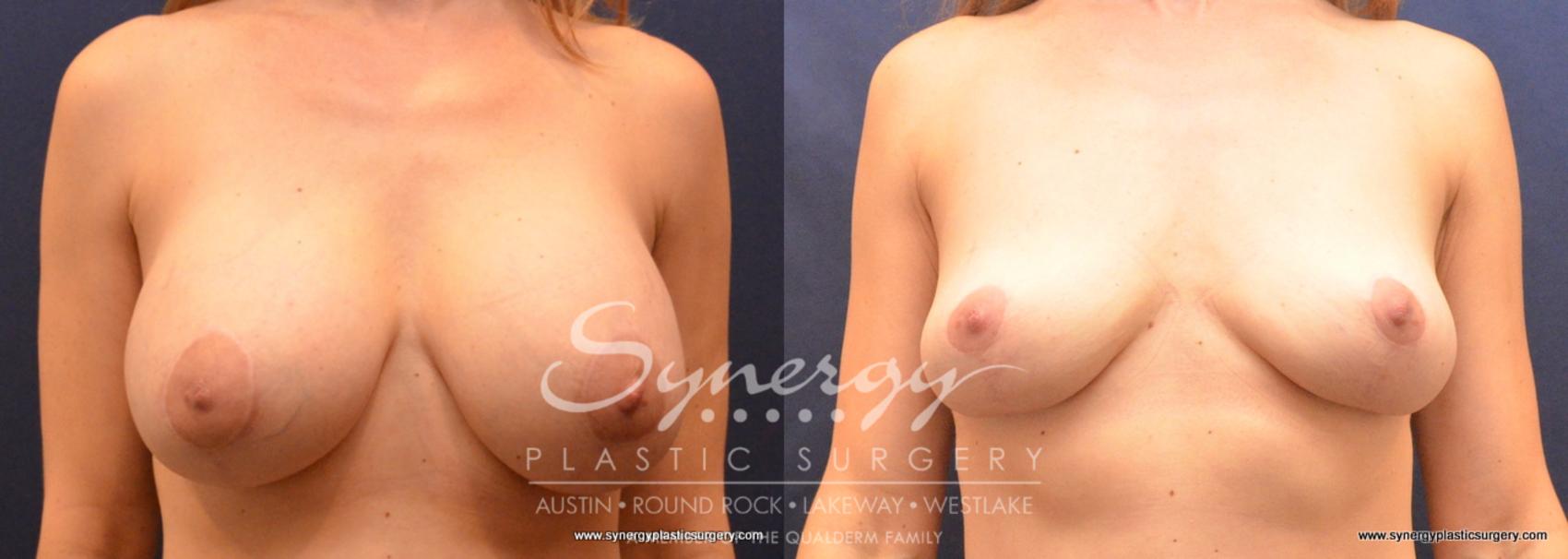 Before & After Breast Implant Removal Case 708 View #1 View in Austin, TX