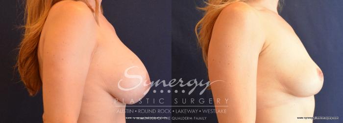 Before & After  Case 708 View #5 View in Austin, TX