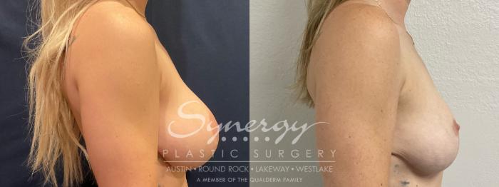 Before & After  Case 859 Left Oblique View in Austin, TX