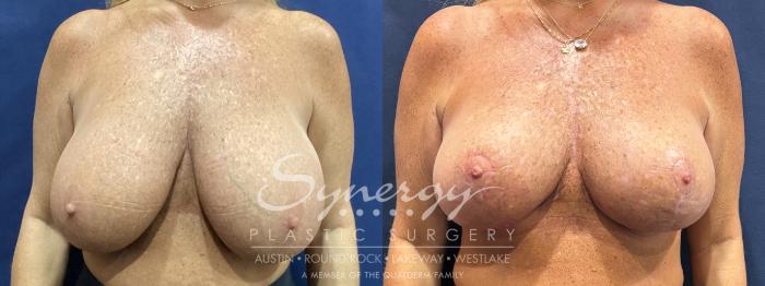 Before & After Breast Lift (Mastopexy) Case 900 Front View in Austin, TX
