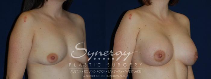 Before & After Breast Lift & Breast Augmentation Case 132 View #3 View in Austin, TX