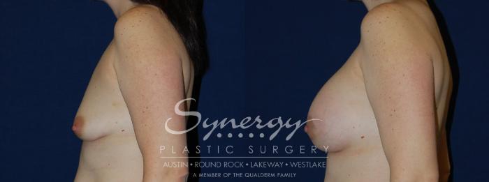 Before & After Breast Lift & Breast Augmentation Case 132 View #4 View in Austin, TX