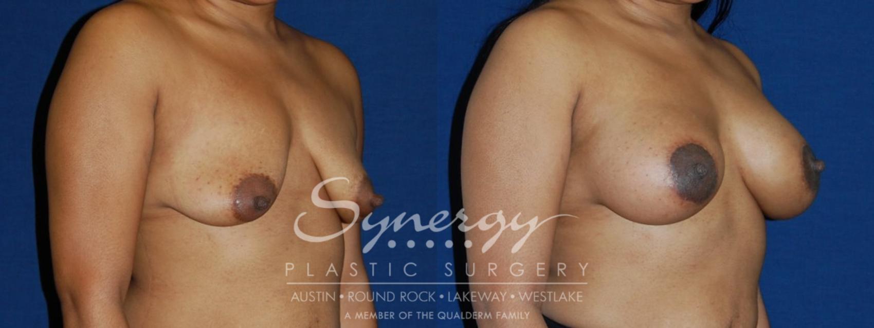 Before & After  Case 133 View #1 View in Austin, TX