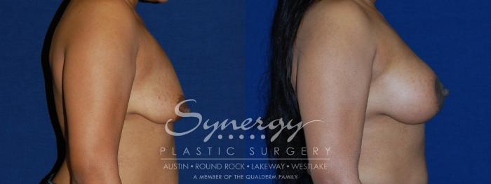 Before & After  Case 133 View #2 View in Austin, TX