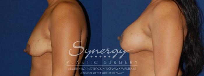 Before & After  Case 133 View #3 View in Austin, TX