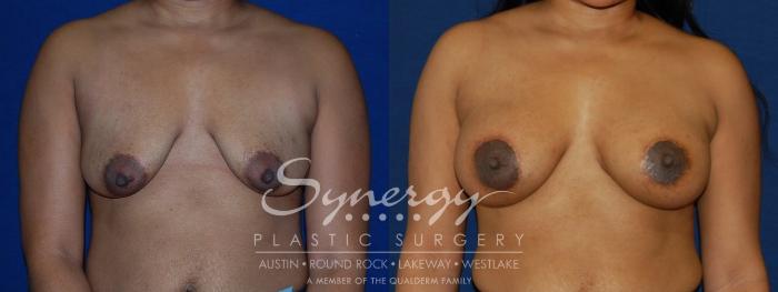 Before & After  Case 133 View #4 View in Austin, TX