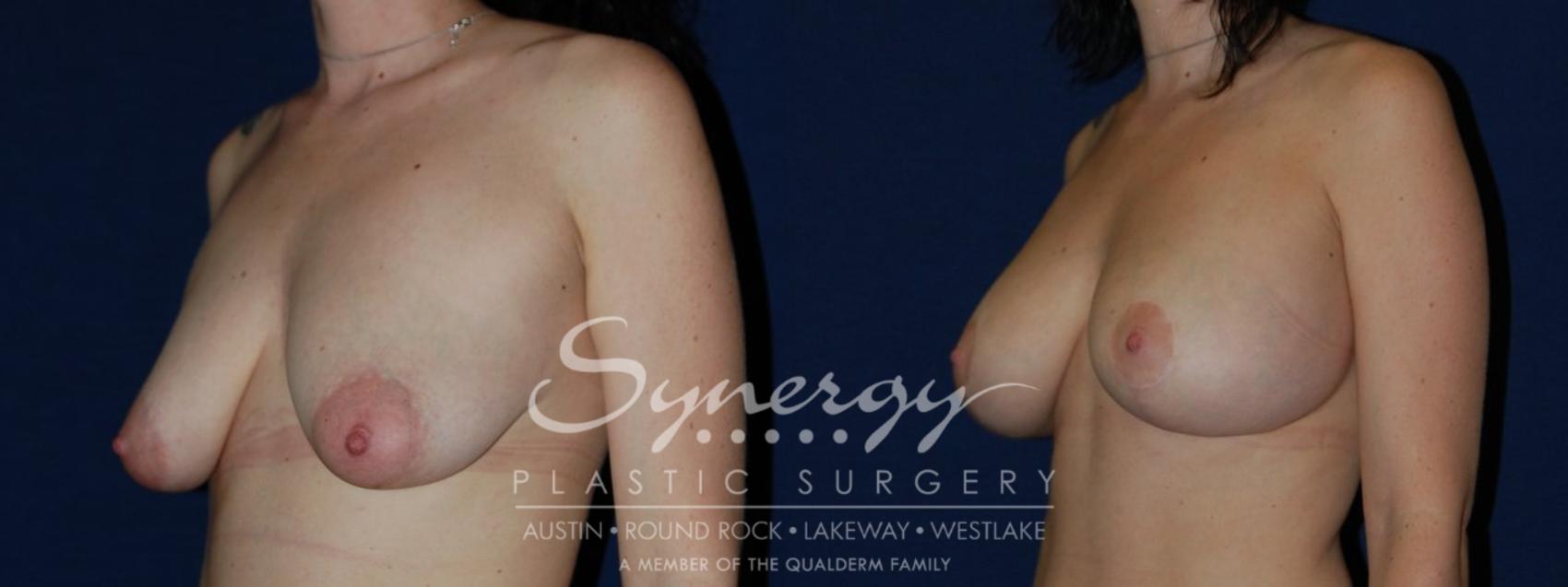 Before & After Breast Lift & Breast Augmentation Case 136 View #1 View in Austin, TX