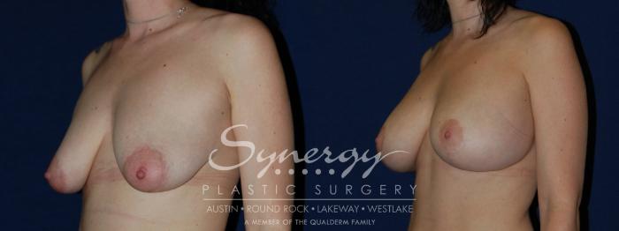 Before & After Breast Lift & Breast Augmentation Case 136 View #1 View in Austin, TX