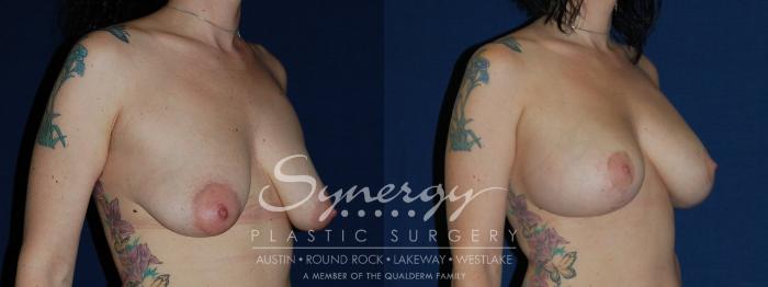 Before & After Breast Lift & Breast Augmentation Case 136 View #3 View in Austin, TX