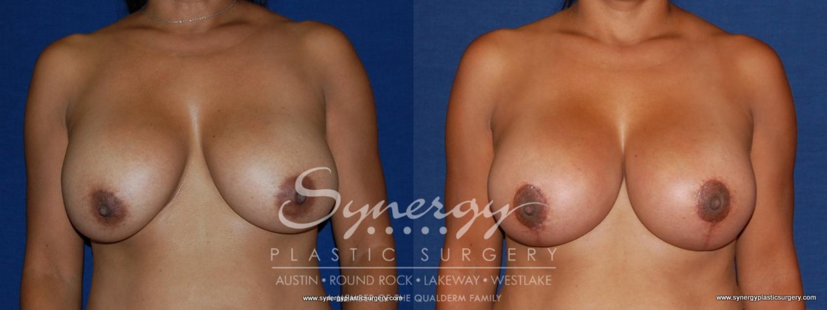 Before & After Breast Lift & Breast Augmentation Case 172 View #1 View in Austin, TX