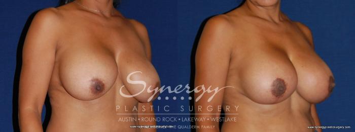 Before & After Breast Lift & Breast Augmentation Case 172 View #2 View in Austin, TX