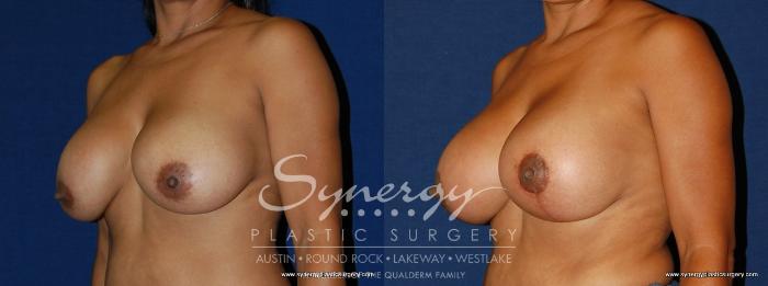 Before & After Breast Lift & Breast Augmentation Case 172 View #3 View in Austin, TX