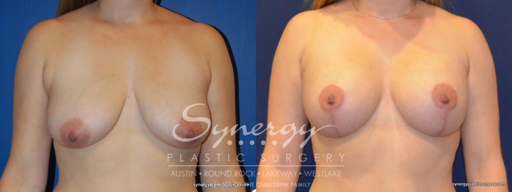 Before & After  Case 274 View #1 View in Austin, TX