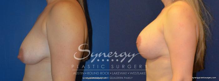 Before & After  Case 274 View #2 View in Austin, TX