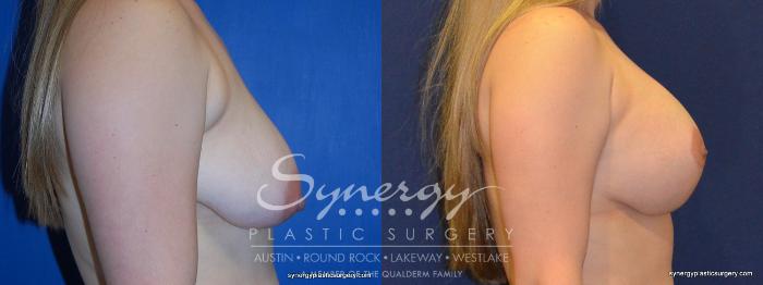Before & After  Case 274 View #4 View in Austin, TX