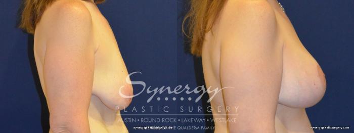 Before & After Breast Lift & Breast Augmentation Case 280 View #2 View in Austin, TX