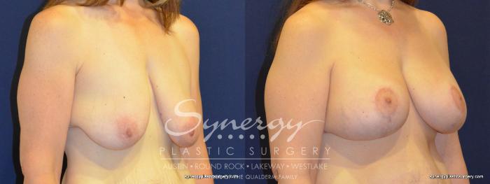 Before & After Breast Lift & Breast Augmentation Case 280 View #3 View in Austin, TX