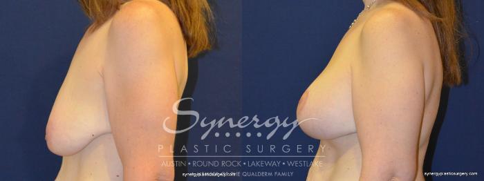 Before & After Breast Lift & Breast Augmentation Case 280 View #4 View in Austin, TX