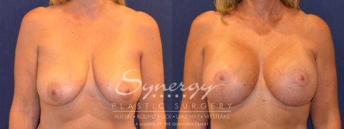 Before & After Breast Lift & Breast Augmentation Case 294 View #1 View in Austin, TX