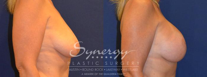 Before & After Breast Lift & Breast Augmentation Case 294 View #2 View in Austin, TX