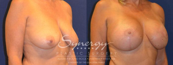Before & After Breast Lift & Breast Augmentation Case 294 View #3 View in Austin, TX