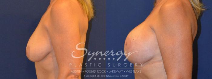 Before & After Breast Lift & Breast Augmentation Case 294 View #4 View in Austin, TX