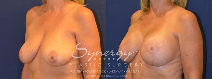 Before & After Breast Lift & Breast Augmentation Case 294 View #5 View in Austin, TX