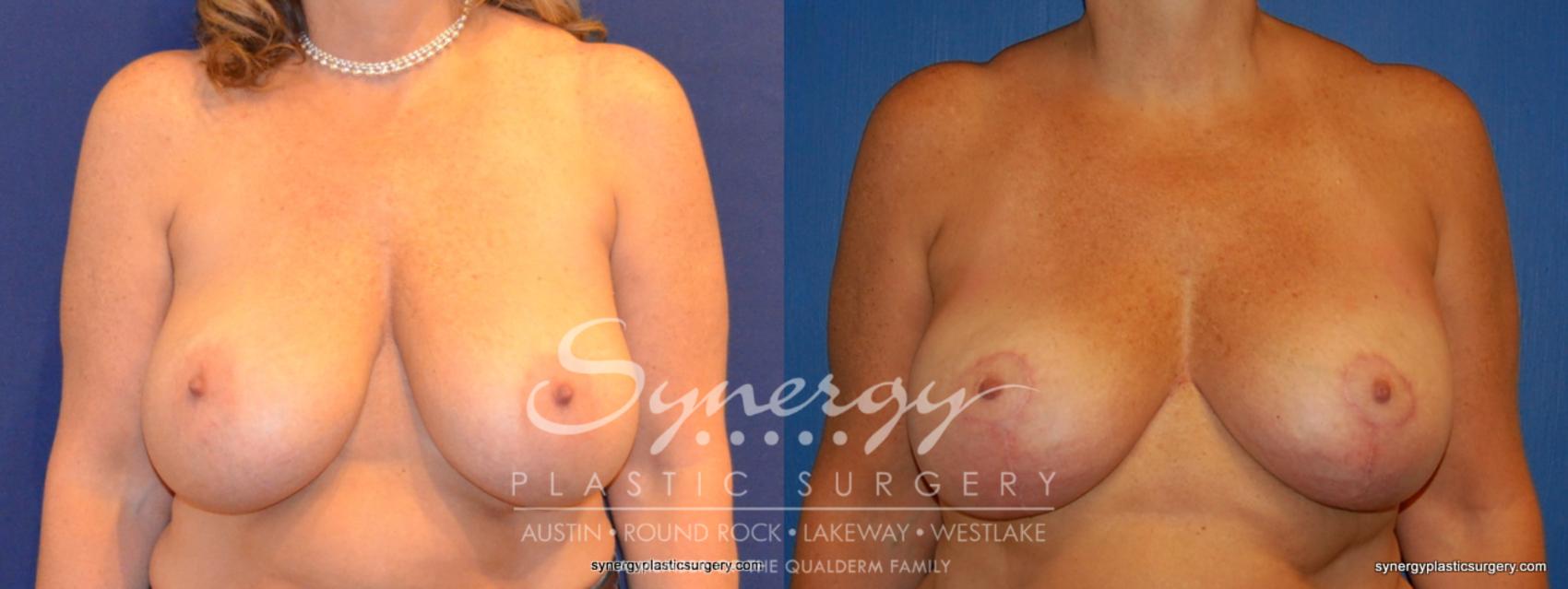 Before & After Breast Lift & Breast Augmentation Case 310 View #1 View in Austin, TX