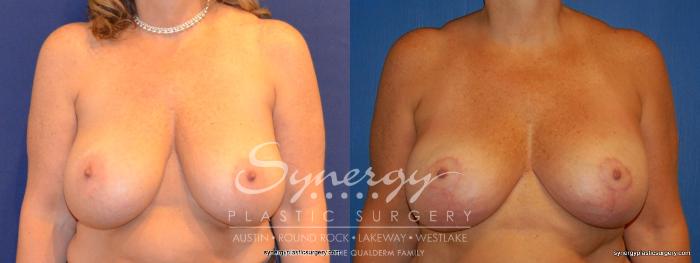 Before & After Breast Lift & Breast Augmentation Case 310 View #1 View in Austin, TX