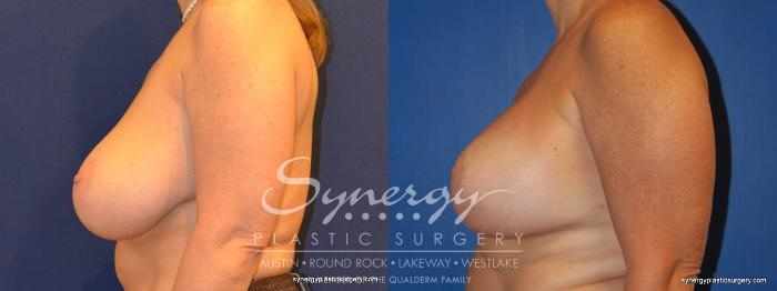 Before & After Breast Lift & Breast Augmentation Case 310 View #4 View in Austin, TX