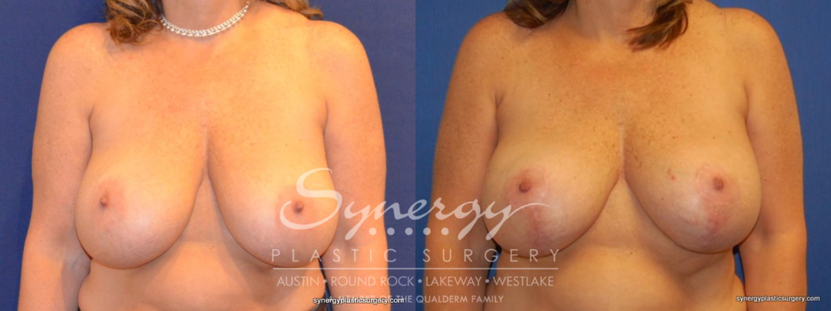 Before & After Breast Lift & Breast Augmentation Case 378 View #1 View in Austin, TX