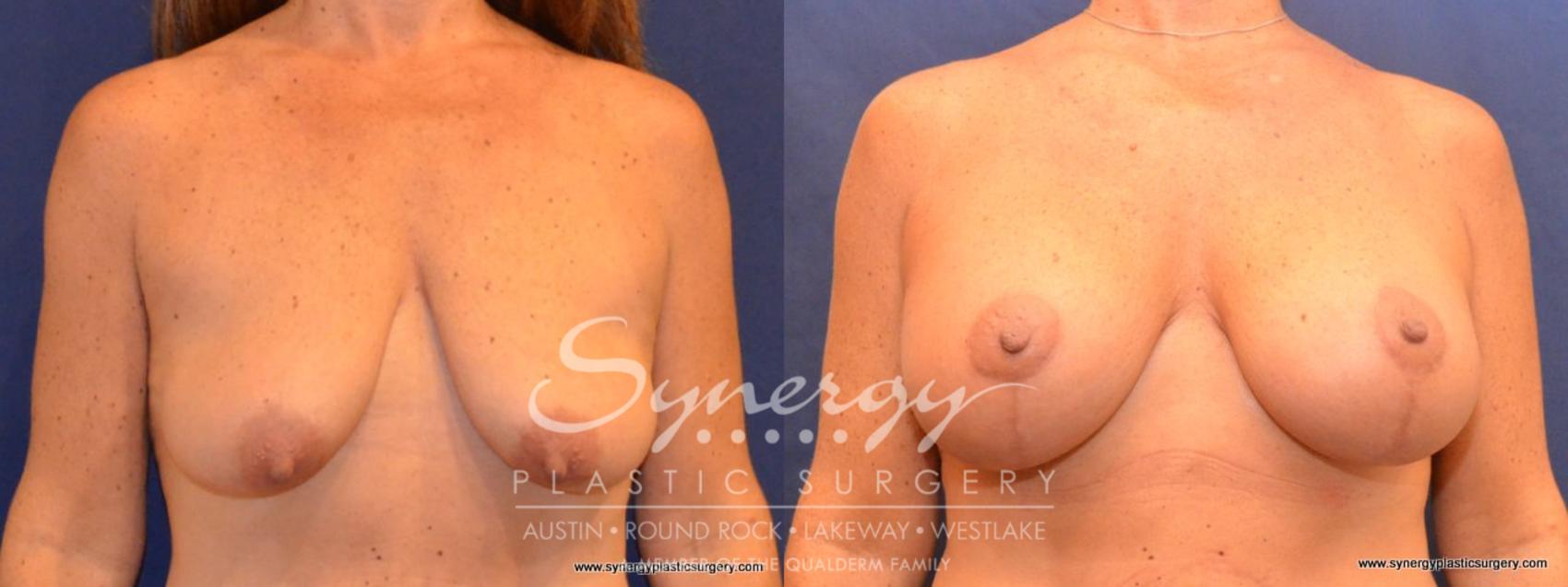 Before & After Breast Lift & Breast Augmentation Case 419 View #1 View in Austin, TX