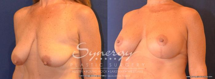Before & After Breast Lift & Breast Augmentation Case 419 View #4 View in Austin, TX