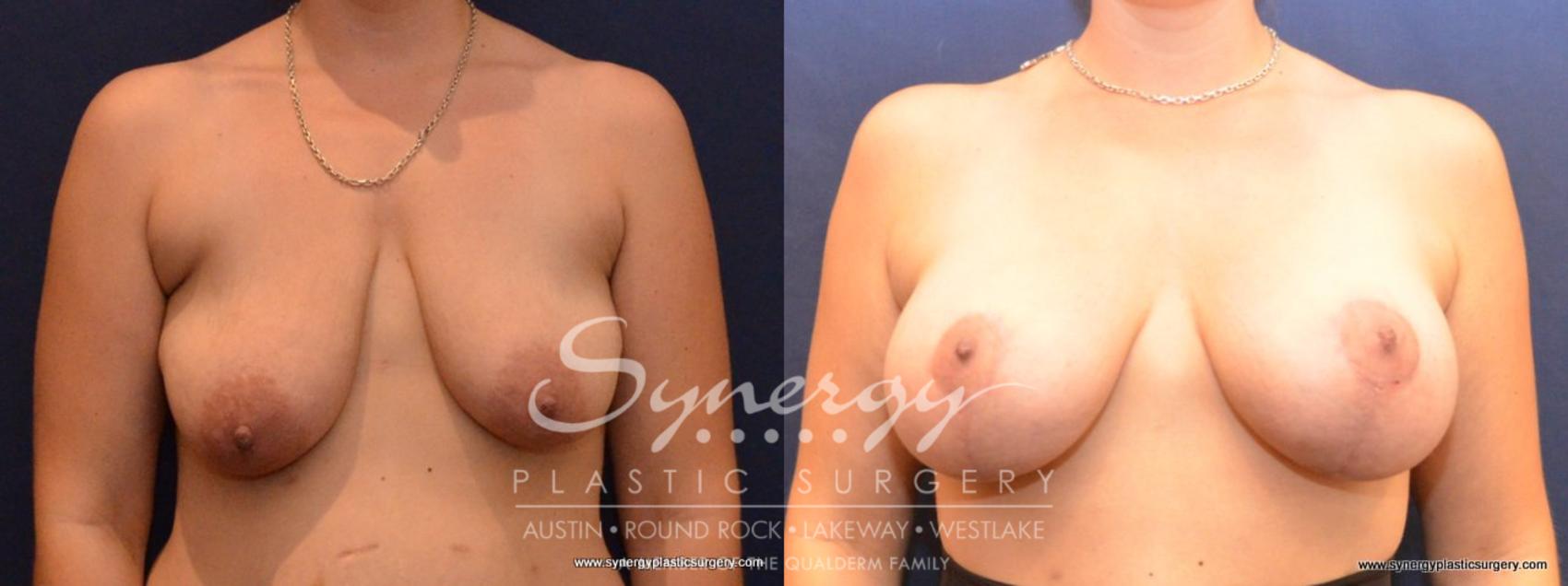 Before & After Breast Lift & Breast Augmentation Case 433 View #1 View in Austin, TX