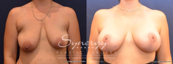Before & After Breast Lift & Breast Augmentation Case 433 View #1 View in Austin, TX
