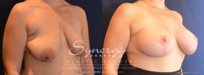 Before & After Breast Lift & Breast Augmentation Case 433 View #3 View in Austin, TX