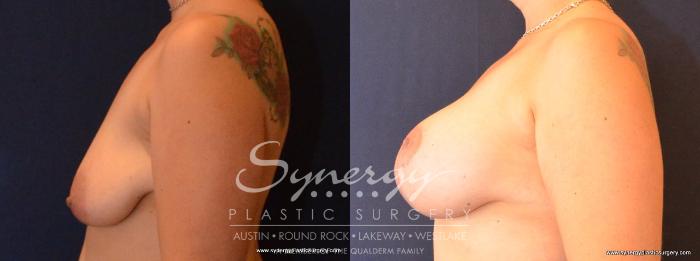 Before & After Breast Lift & Breast Augmentation Case 433 View #4 View in Austin, TX