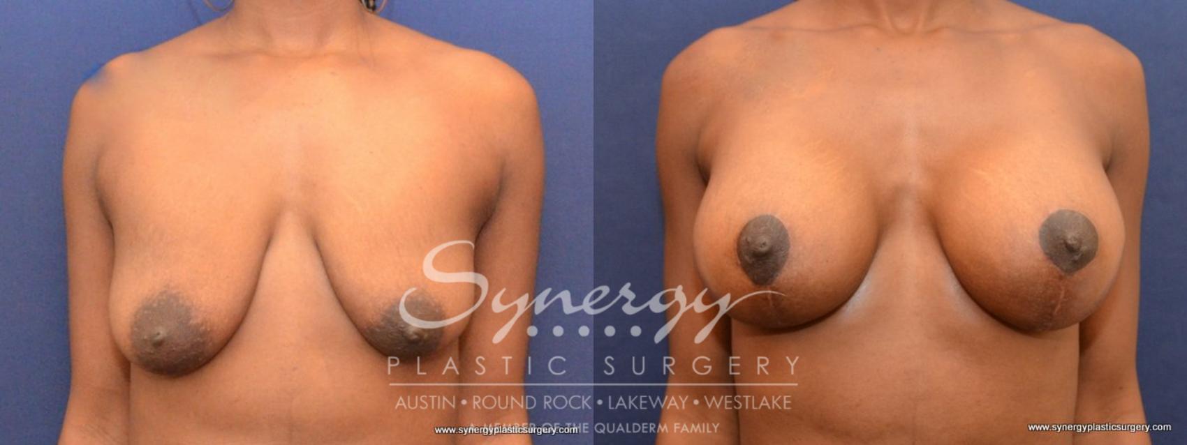 Before & After Breast Lift & Breast Augmentation Case 440 View #1 View in Austin, TX