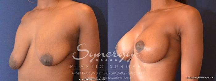 Before & After  Case 440 View #2 View in Austin, TX