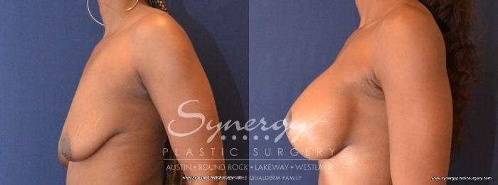 Before & After  Case 440 View #3 View in Austin, TX