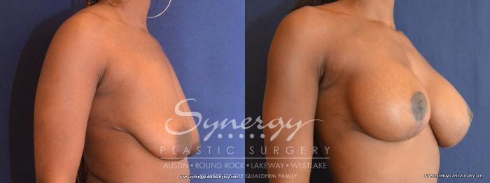 Before & After  Case 440 View #4 View in Austin, TX