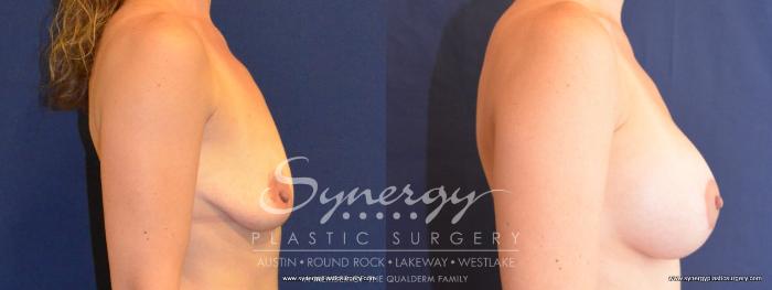 Before & After Breast Lift & Breast Augmentation Case 451 View #2 View in Austin, TX
