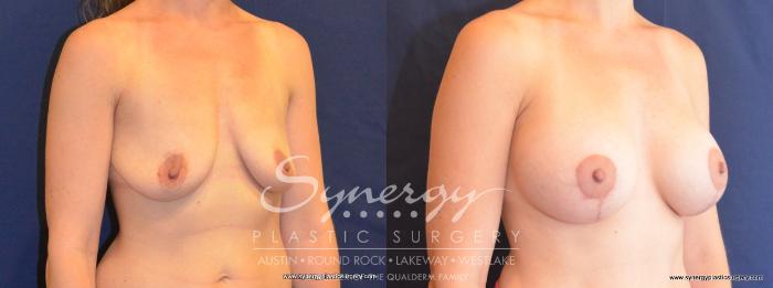 Before & After Breast Lift & Breast Augmentation Case 451 View #3 View in Austin, TX