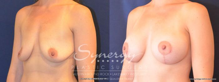 Before & After Breast Lift & Breast Augmentation Case 451 View #5 View in Austin, TX