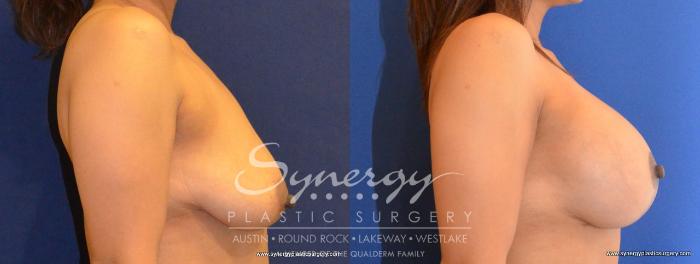Before & After  Case 463 View #4 View in Austin, TX