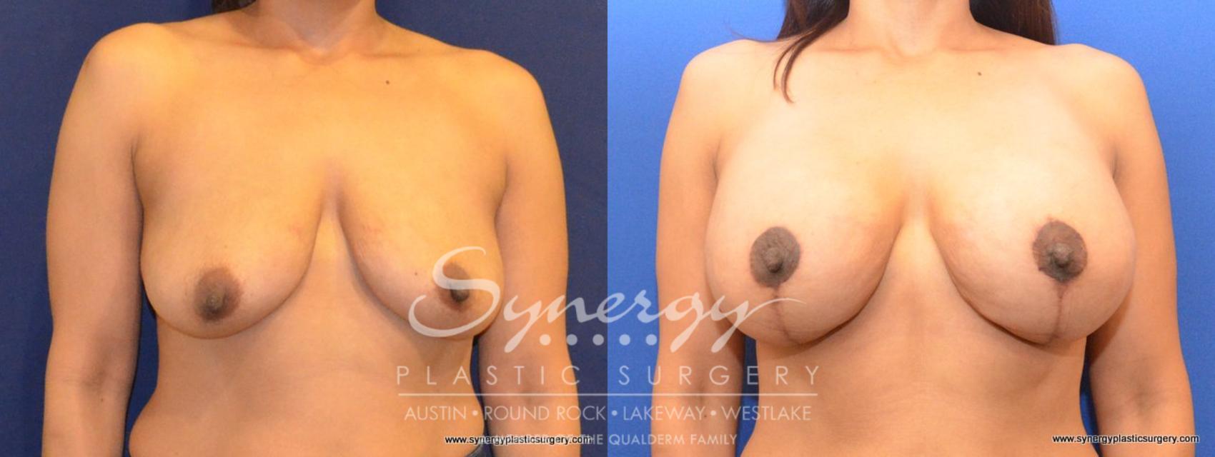 Before & After Breast Lift & Breast Augmentation Case 463 View #5 View in Austin, TX