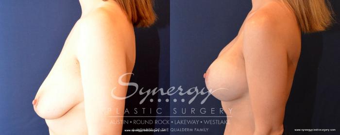 Before & After Breast Lift & Breast Augmentation Case 496 View #3 View in Austin, TX